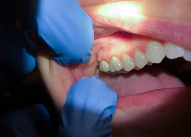 Best Tooth Infection Emergency Dentist  in Hasson Heights, PA